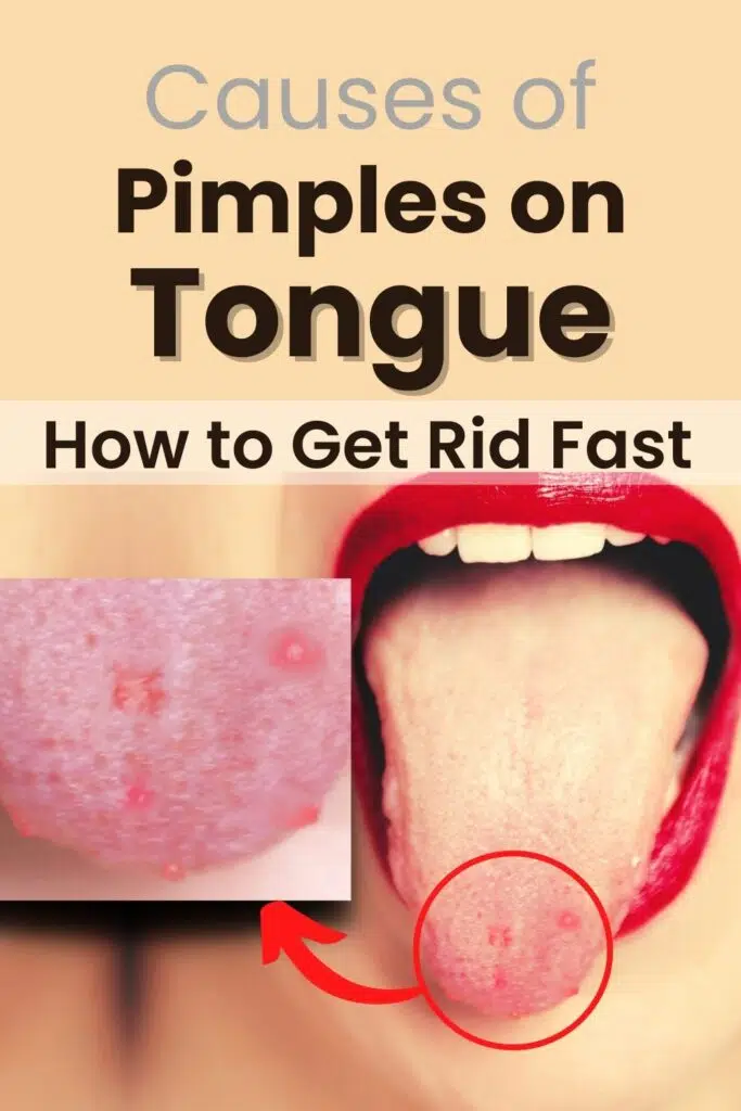 Lie Bumps: Pimples on tongue