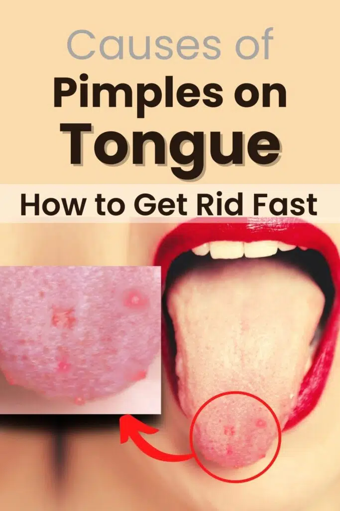 Pimples On Tongue Lie Bumps Tongue Causes Get Rid Of It MG