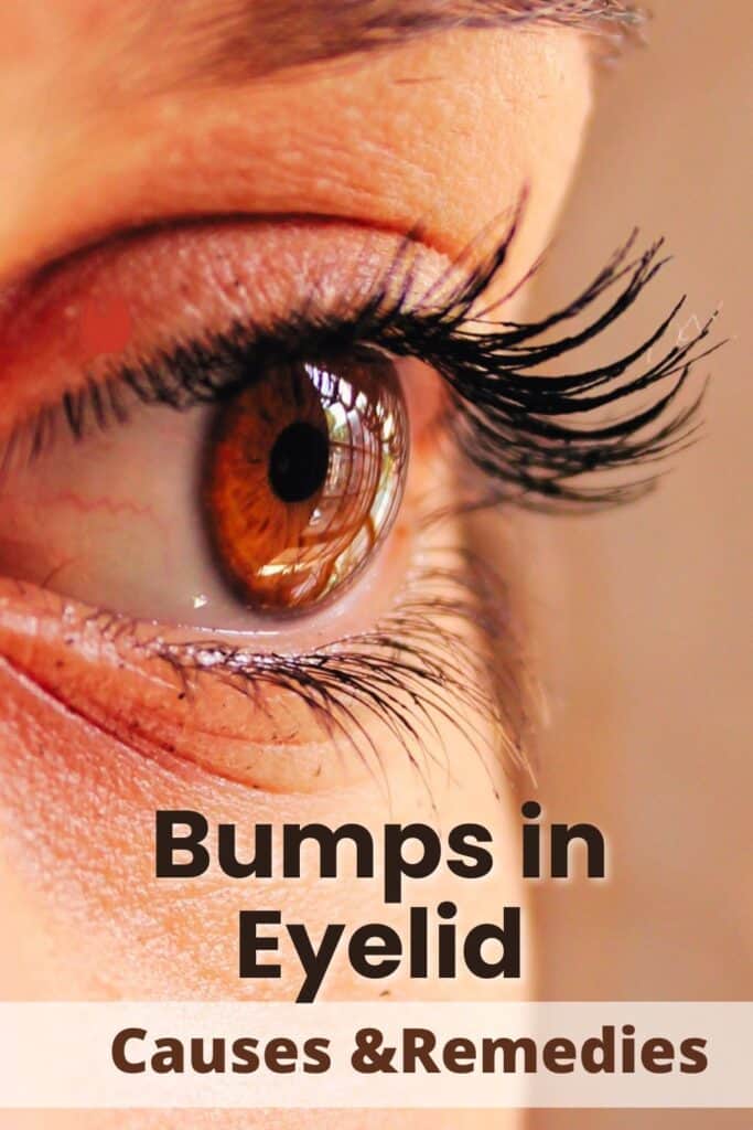 Itchy Bumps In Eyelid Causes Remedies And Treatment Mg