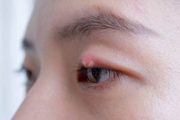 Itchy Bumps In Eyelid Causes Remedies And Treatment Mg 